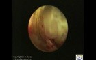Cervical Ectopic Pregnancy 