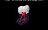 Mandibular Third Molar - Root Canal Anatomy