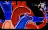 Ductus in Tetralogy of Fallot
