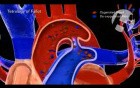 Ductus in Tetralogy of Fallot