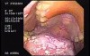 Oropharynge-Esophagic Candidiasis (2 of 5)
