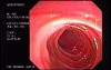 Familial Adenomatous Polyposis of the Colon (23 of 29)