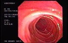 Familial Adenomatous Polyposis of the Colon (23 of 29)