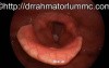 A Mass on The Vocal Cord