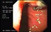 Flexible Endoscopic Suturing - Loosing the Tissues