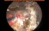 Greenlight HPS - Prostatic Calculi
