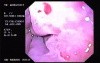 Hemorrhage due status post rubber band ligation of esophageal varices (3 of 25)