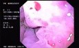Hemorrhage due status post rubber band ligation of esophageal varices (3 of 25)
