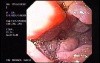 Duodenal B Cell Lymphoma (6 of 7)