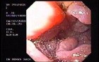 Duodenal B Cell Lymphoma (6 of 7)