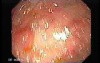 Familial Adenomatous Polyposis (9 of 36)