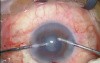 Combined Phaco Trab