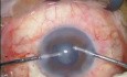 Combined Phaco Trab