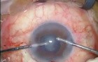 Combined Phaco Trab