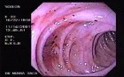 Diverticular Disease - Hemorrhage (11 of 15)