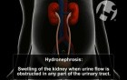 Hydronephrosis