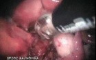Laparoscopic Miles' Intervention (The Abdominoperineal Excision)