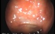 The Passavant's Ridge-Velopharyngeal Isthmus Closure