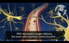 Fetal Effects of Cord Prolapse