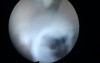 Sticking Walls of Endometrium as a Result of Intrauterine Trauma