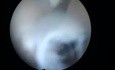 Sticking Walls of Endometrium as a Result of Intrauterine Trauma