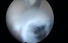 Sticking Walls of Endometrium as a Result of Intrauterine Trauma