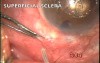 Pseudophakic glaucoma treatment with microtrack filtration