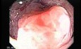 Rectal Adenocarcinoma - Colonoscopy (8 of 8)
