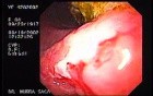 Ulcerative Pre - Pyloric Adenocarcinoma - Signet Ring Cells