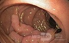 Duodenal Tubulovillous Adenoma
