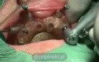 Nobel Guide Implant Surgery- The Insertion Of 8 Implants Into Maxilla