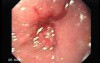 Adenocarcinoma of the Middle Third of Esophagus - Closer Look at the Tumor