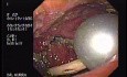 Partial Dehiscence of Suturing with Gastro-cutaneous Fistula (1 of 4)
