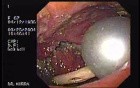 Partial Dehiscence of Suturing with Gastro-cutaneous Fistula (1 of 4)