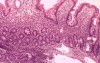 Gastric lymphoma with metastases to the duodenum (15 of 15)