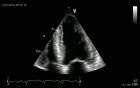 Longitudinal Left Ventriculi Dysfunction Cardiac Amyoidosis