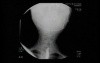 Esophageal Achalasia - Barium Swallow