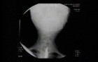 Esophageal Achalasia - Barium Swallow