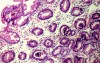 Intestinal Metaplasia (5 of 5)