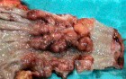 Barrett Adenocarcinoma - Endoscopic Image (20 of 20)