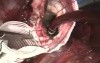Aneurysm of Ascending Aorta Repairment