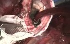 Aneurysm of Ascending Aorta Repairment