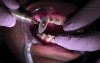 Interproximal Reduction