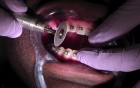 Interproximal Reduction