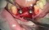 Immediate implantation