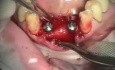 Immediate implantation