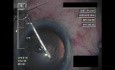 Cataract Surgery XI - Part 1