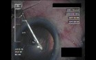 Cataract Surgery XI - Part 1