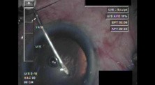 Cataract Surgery XI - Part 1