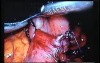 Jejunal Gastrointestinal Stromal tumor (GIST) (51 of 86)